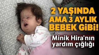 2 Yaşındaki Hallerman Streiff Sendromlu Minik Hira Yardım Bekliyor [upl. by Caldeira]