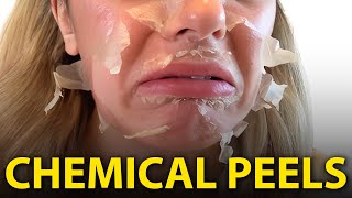 Will Chemical Peels DESTROY Your Face [upl. by Aened692]