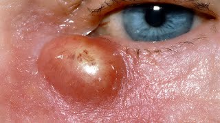 Lacrimal Abscess [upl. by Ymot]