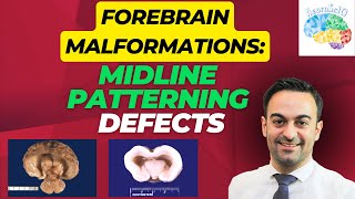 Forebrain Malformation Midline Patterning Defects [upl. by Alek]