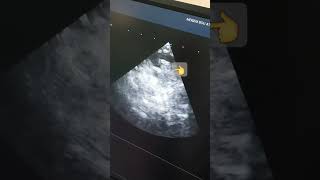 pocus echodoppler de veine et artère jugulaire [upl. by Ytte]