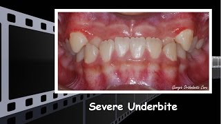 Severe Underbite Treatment [upl. by Imojean]