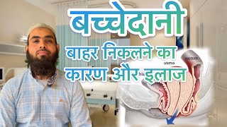 बच्चेदानी के खिसक आने का कारण और उसका इलाज ।what is uterus prolapse amp its exercisePelvic floor इलाज [upl. by Hannah708]