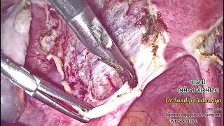 hysterectomy myomectomy fibrodectomy [upl. by Heti]