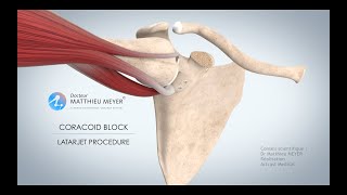 SHOULDER STABLISATION BY CORACOID BLOCK LATARJET PROCEDURE  DR MATTHIEU MEYER  PARIS FRANCE [upl. by Norby]