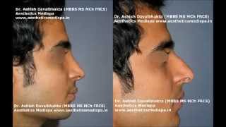 Rhinoplasty at Aesthetics Medispa Pune India [upl. by Hildie]