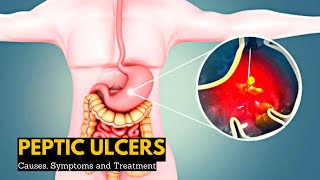 Peptic Ulcers Causes Signs and Symptoms Diagnosis and Treatment [upl. by Brott623]