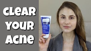 HOW TO CLEAR YOUR SKIN WITH BENZOYL PEROXIDE DR DRAY [upl. by Itsrik128]