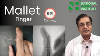 Mallet Finger Treatment In Hindi Dr Karoon Agrawal [upl. by Malorie]