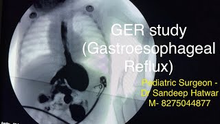 Gastroesophageal Reflux GER study [upl. by Krasner495]