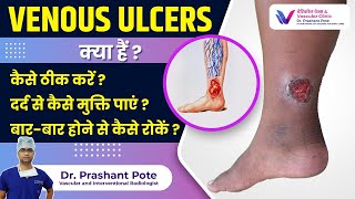 Venous Ulcers के लिए रामबाण इलाज Dr Prashant Pote द्वारा सलाह [upl. by Arch]