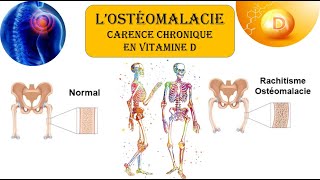 LOSTEOMALACIE🦴  la CARENCE en VITAMINE D ☀️ [upl. by Charisse11]