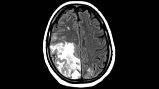 Hemorrhagic Infarct Secondary to Dural Sinus Thrombosis [upl. by Releehw]