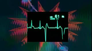 270 VOIR UN ARRÊT CARDIAQUE EN DIRECT ISCHEMIE ÉCLECRTIQUE A ECG COMPLIQUÉE D UN TACHYCARDIE V [upl. by Anniroc419]