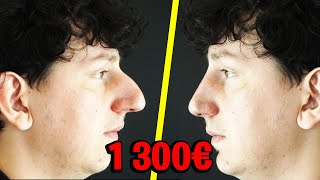 Jai fais une rhinoplastie en France pour 1300€ Résultat bluffant [upl. by Beaudoin691]