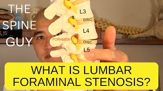 What is Lumbar Foraminal Stenosis [upl. by Bore]