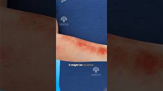 Why Does Eczema Happen shorts viralvideo  Creativelearning3d [upl. by Nylyaj]