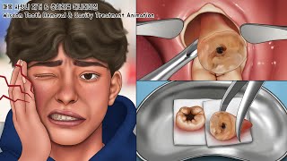 ASMR 매복 사랑니 제거 amp 충치치료 풀버전  치아미백  Wisdom Tooth amp Cavity Treatment Animation [upl. by Isaacs]