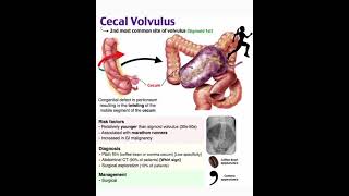 Cecal volvulus [upl. by Storz]