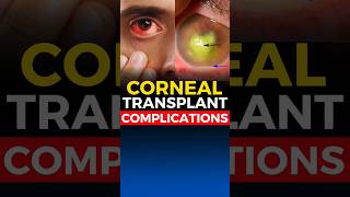 Corneal Transplant Complications [upl. by Ailssa]