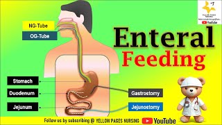 Enteral Feeding  Enteral Tube Feeding  ROUTES  NGT  NDT  NJT  OGT  Gastrostomy  Jejunostomy [upl. by Mikkanen]