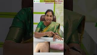 Urticaria  DrA Anitha Yugeshwaran BSMS  SIVANI SIDDHA  urticaria dranitha siddha [upl. by Hughmanick]