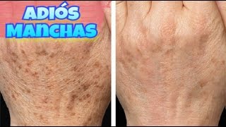 Como quitar las manchas de las manos por completo Remedio 100 efectivo [upl. by Modern582]