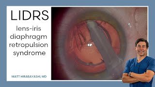 LIDRS lensiris diaphragm retropulsion syndrome Explanation and Demonstration [upl. by Oflunra]