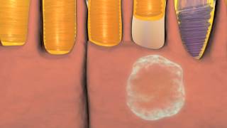 Animation of Wet and Dry Macular Degeneration [upl. by Ddet]