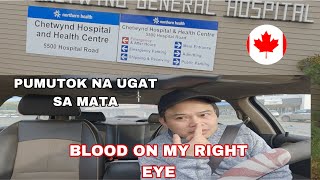 PUMUTOK NA UGAT SA MATA  BLOODSHOT EYE [upl. by Atteuqaj]