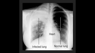 White Lung Syndrome [upl. by Dorwin260]