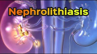 Nephrolithiasis Kidney Stones  CRASH Medical Review Series [upl. by Notgnirra93]