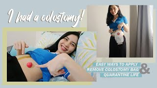 HOW TO APPLY AND REMOVE COLOSTOMY BAG  MEDREPLIFE [upl. by Pippo]