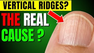 The Shocking Reasons Behind Vertical Nail Lines [upl. by Engedi]