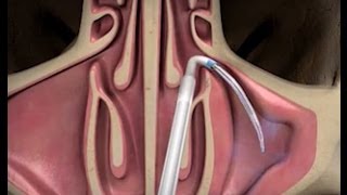 Balloon Sinuplasty Procedure with ENT Dr Timothy Ragsdale [upl. by Sharity]