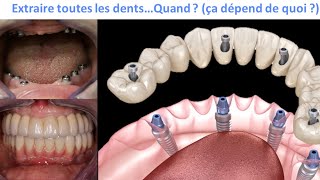 All on 4  Quand extraire les dents [upl. by Lekim]