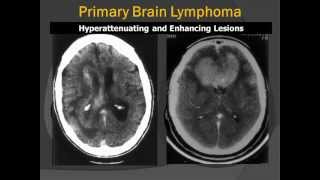 Corpus Callosum Primary CNS Lymphoma PCNSL RadiologicPathologic Correlation [upl. by Romina]