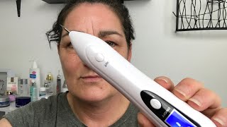 Fibroblast treatment At Home [upl. by Kendal]