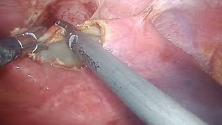 hydatid cyst surgery at Bombay hospital Indore [upl. by Senilec]