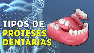 TIPOS DE PRÓTESES DENTARIAS [upl. by Masson]