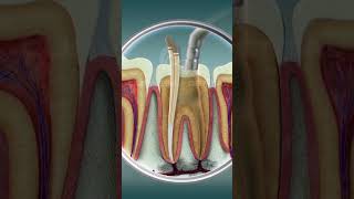 Root Canal Treatment  Curveia Dental I RCT [upl. by Amin]