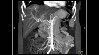 Abdomen Liver Liver AVM 3D mapping demonstrates a vascular lesion in the dome of the liver [upl. by Aihsinat]