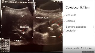 Análisis de imágenes de ecografía de hígado y vesícula biliar  PodCast [upl. by Rockafellow]