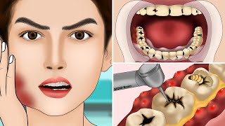 ASMR Molar Tooth Caries Removal so Satisfying part3  Dental Care Animation  어금니 우식증 제거 너무 만족 [upl. by Einad]