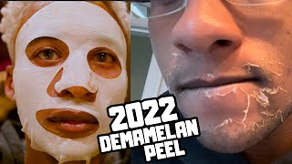 Dermamelan Peel 2022 Chemcial Peel for Severe hyperpigmentation [upl. by Cosma306]