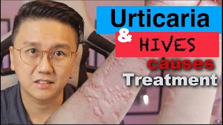 URTICARIA amp HIVES  Causes and Treatment of Itchy Skin Rash [upl. by Eojyllib734]