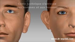 Technique earfold pour les oreilles décollées  Dr Wycisk [upl. by Gnuh]