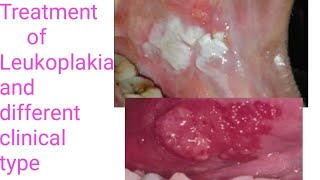 Treatment of LeukoplakiaTypes of Leukoplakia Different treatment modalities of Leukoplakia PVLVH [upl. by Farmer]