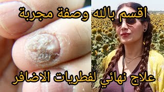 علاج طبيعي لفطريات الاظافر mycose des ongles بسرعة متنسايش دعي معايا بعد الوصفة [upl. by Rondon411]