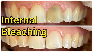 30 years old female  tooth discoloration  internal bleaching  Dr Sara  dentist  Bleaching [upl. by Nyleek289]